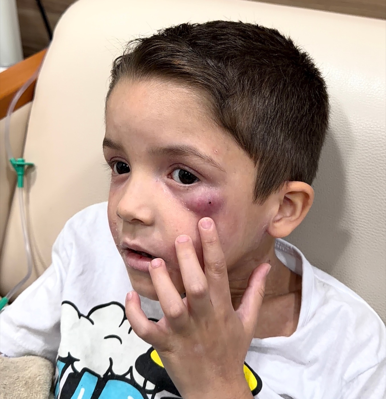Luicito mostrando la inflamación en su mejilla durante una consulta