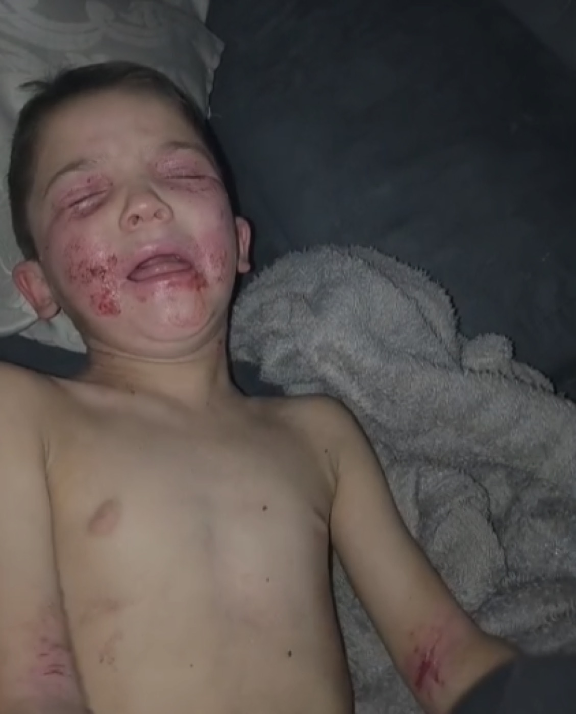 Luicito durante una crisis nocturna de dermatitis atópica