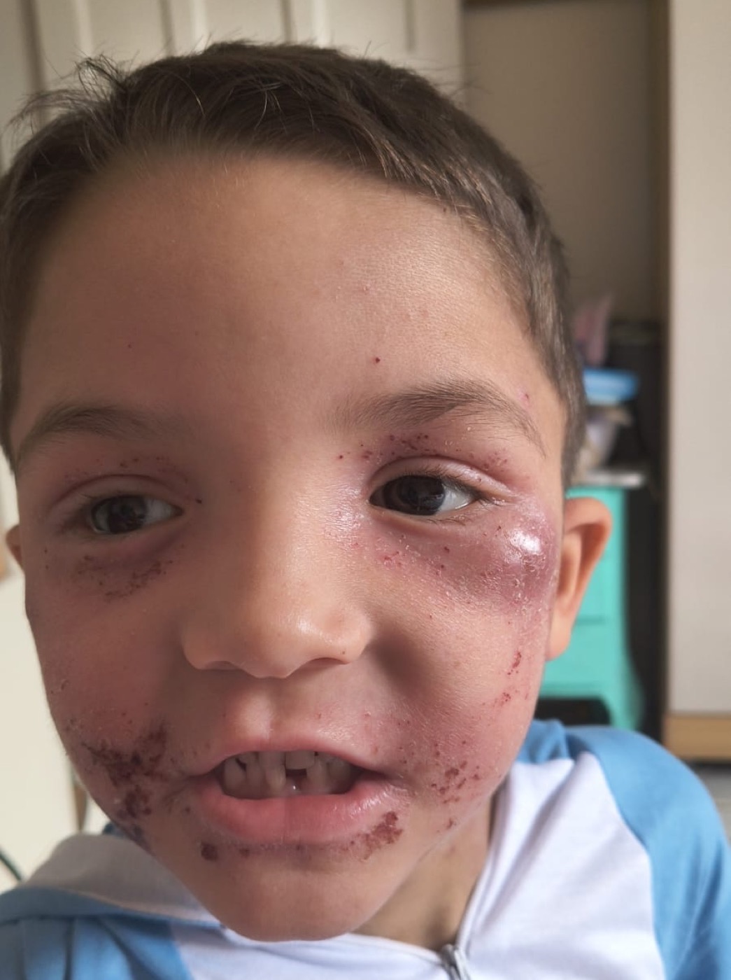 Luicito en casa tras una crisis de dermatitis atópica